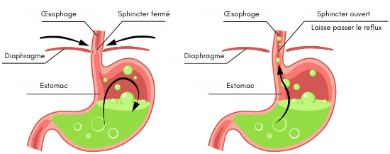 Représentation de l'estomac et du sphincter œsophagien.